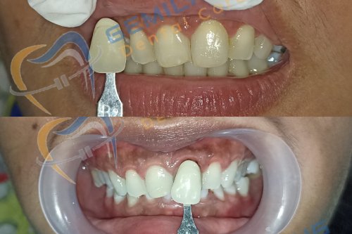 Pemutihan Gigi Bleaching